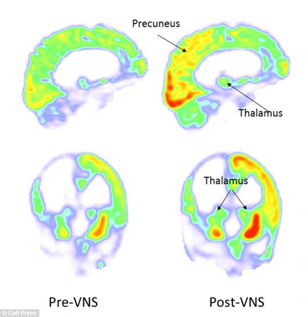 Imagens da linha de base ( esquerda, pr-VNS) e 3 meses aps a estimulao do nervo vago (no direito, ps-VNS). O metabolismo aumentou no crtex parieto-occipital direito, tlamo e estriado. Foto: Corazzol et al.