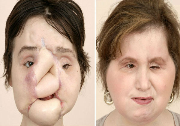 Antes e depois do transplante Foto: Cleveland Clinic