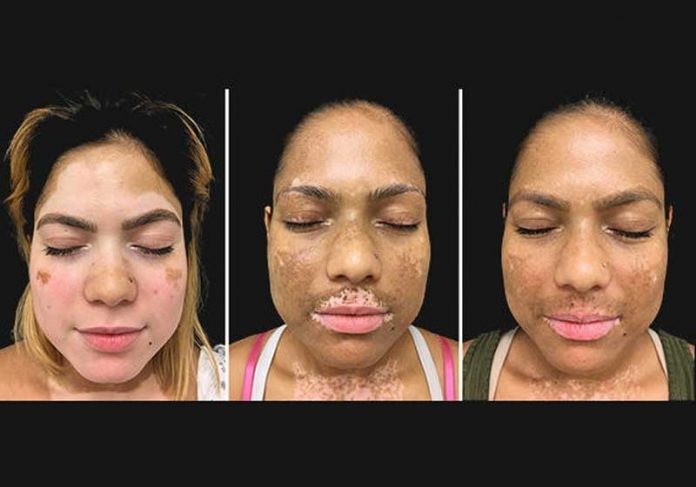 Se Cura El Vitiligo Con Protopic