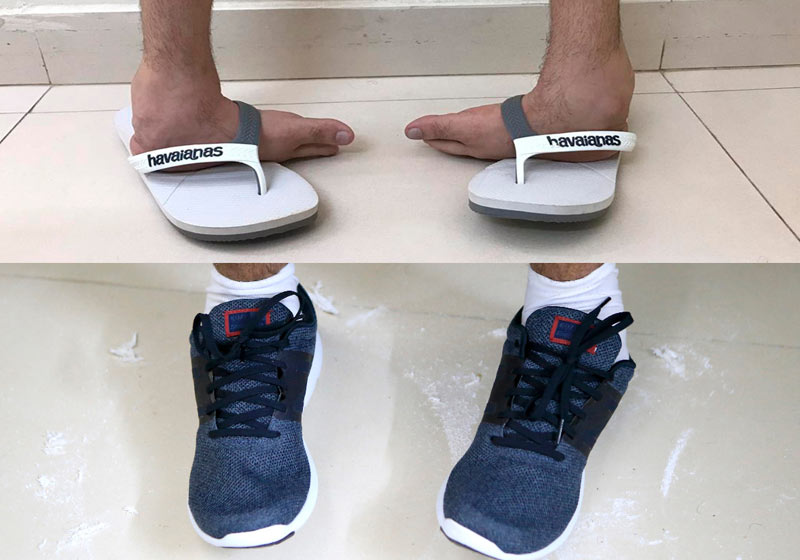 tenis ortopedico para pe torto