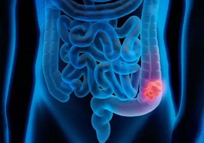 Dr. Sagar Sengupta encontrou uma forma mais simples de identificar o câncer de cólon - Foto: Pixabay