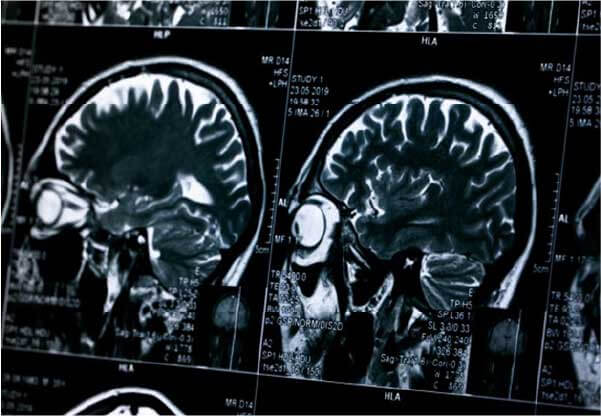 Ressonância do antes e depois do uso dos eletrodos - Foto: reprodução 