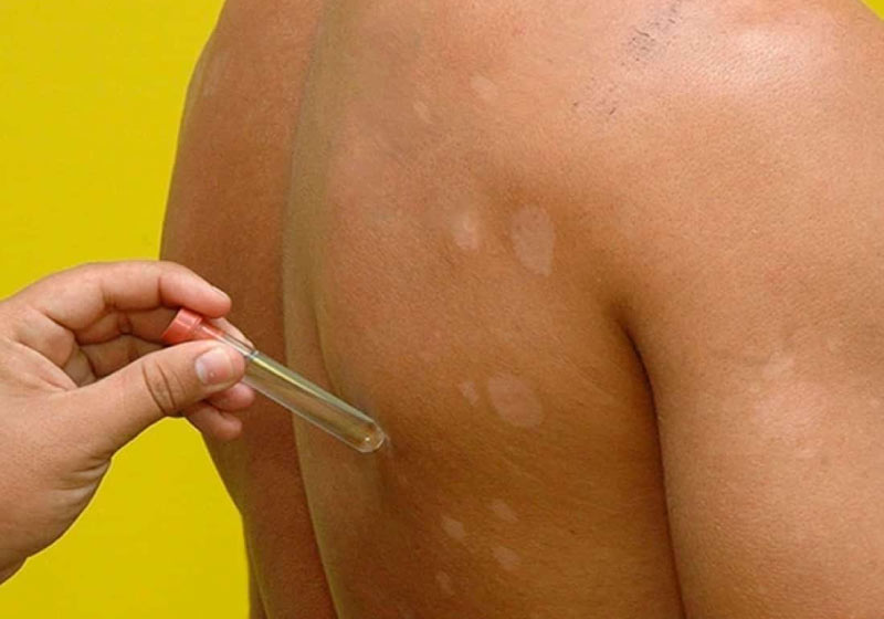 O teste molecular para hanseníase é o primeiro do tipo, lançado no Brasil - Foto: reprodução